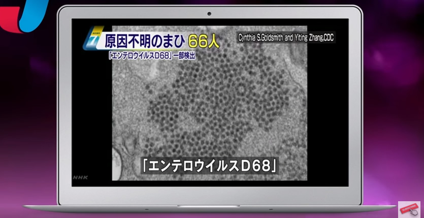 &nbspUnidentified paralysis afflicts 66 across Japan over four months in ’15, some with Enterovirus